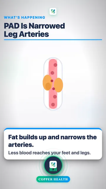 Leg Pain When You Walk
