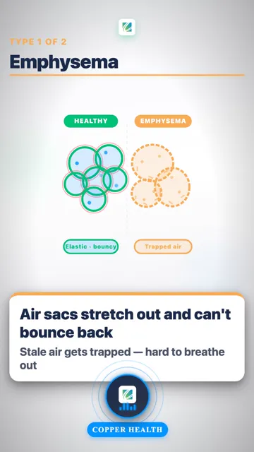 Chronic Bronchitis